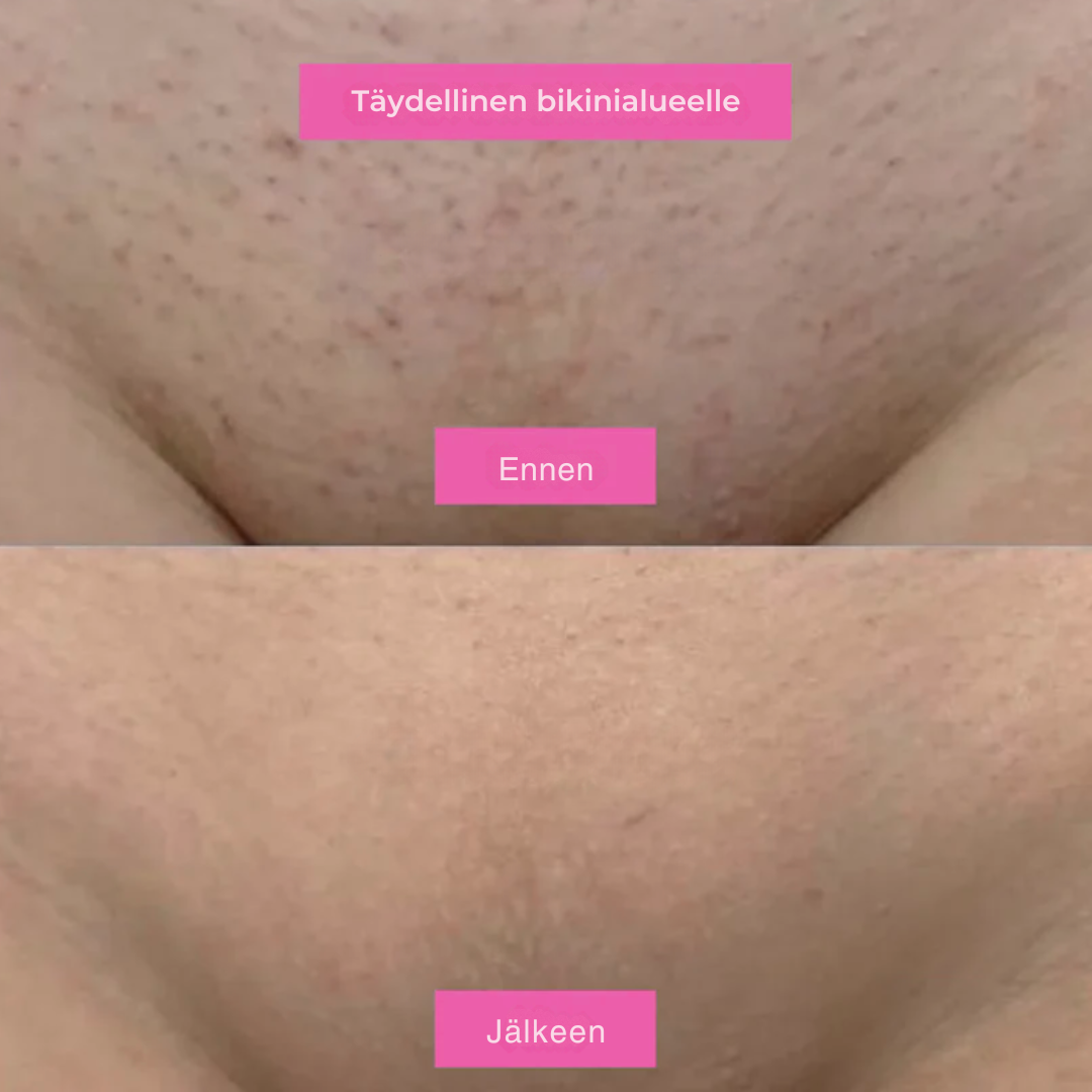 Karvanpoistoöljy – Luonnollisen sileä iho ilman höylää