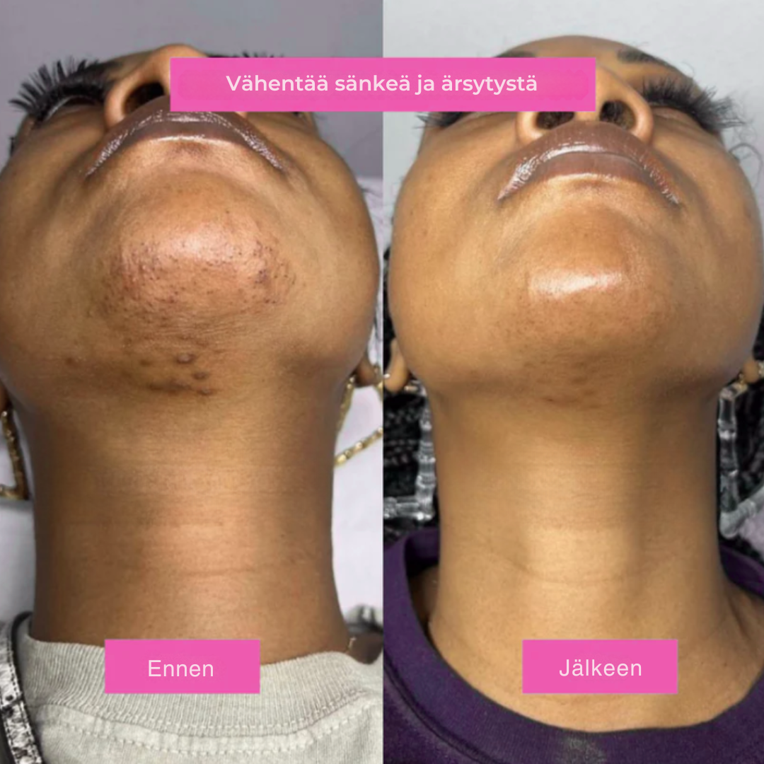 Karvanpoistoöljy – Luonnollisen sileä iho ilman höylää